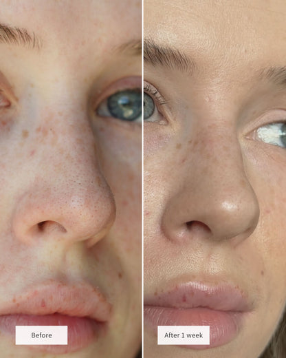 ClearSkin Nose Patches
