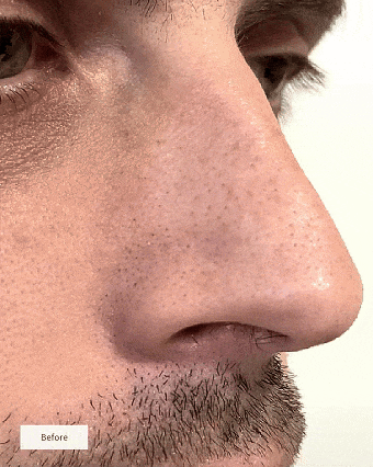 ClearSkin Nose Patches