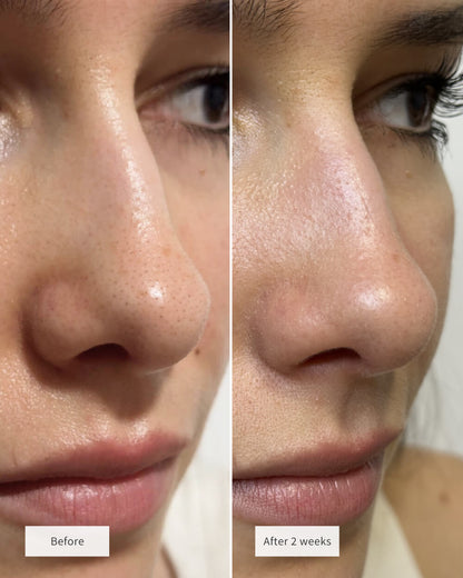 ClearSkin Nose Patches